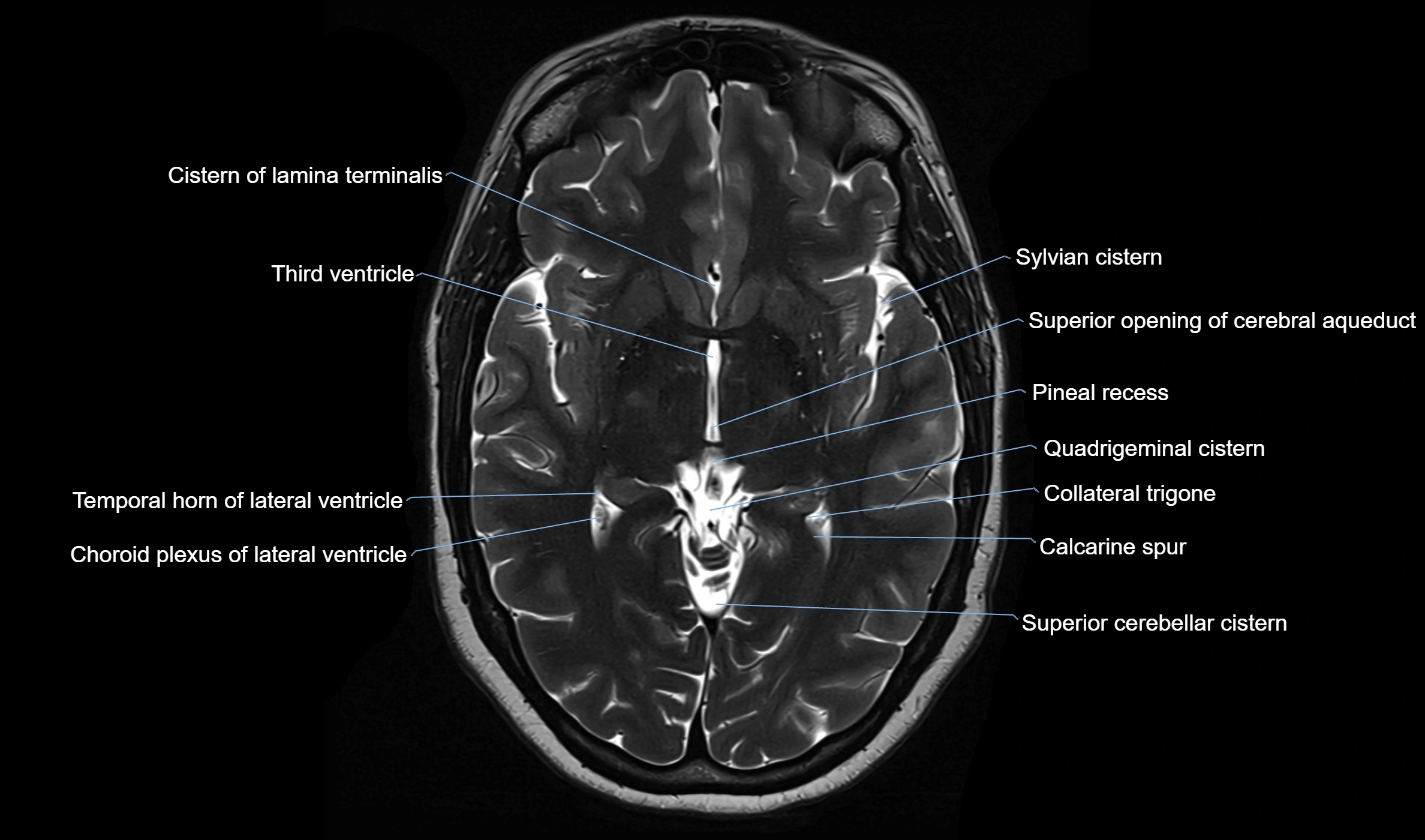 Brain cisterns  and ventricles  axial anatomy 3T MRI image-img-00001-00026.webp